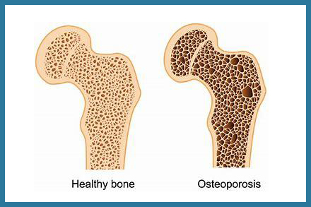 Osteoporosi: Le 5 mosse per mantenere le ossa sane