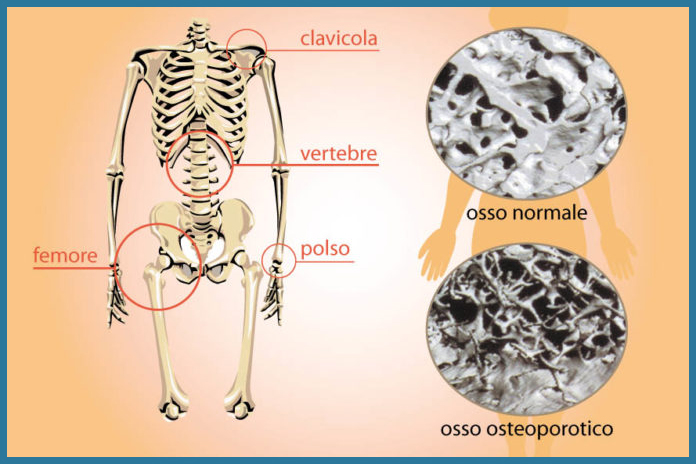 Come convivere con l’osteoporosi