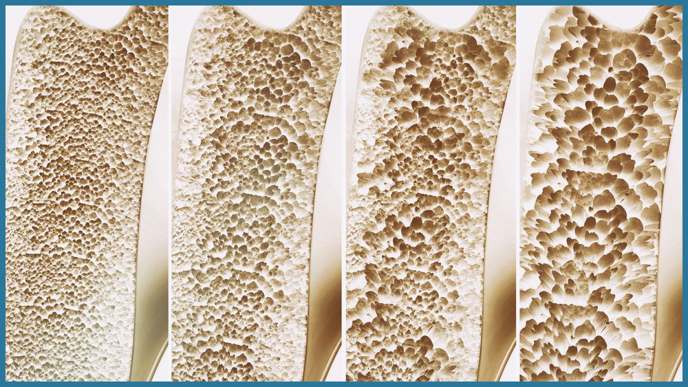 La Fisiopalestra: un valido alleato contro l’Osteoporosi